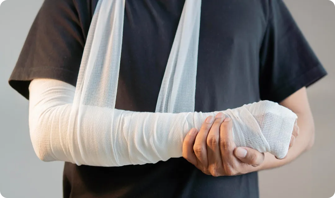 Close-up of a person wearing a black shirt with a fully bandaged arm in a white sling.